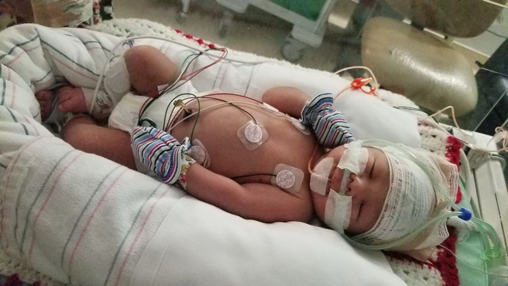 Little newborn in a NICU bed hooked up to nasal oxygen, heart monitor wires, and more and more tunes 