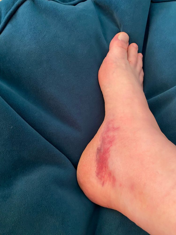 Bruised / swollen arch