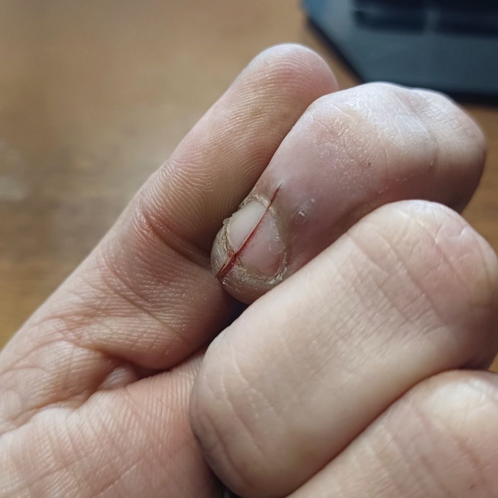 Detalhe da minha mão com o corte mais recente no meu dedo indicador, tendo cortado inclusive a unha.