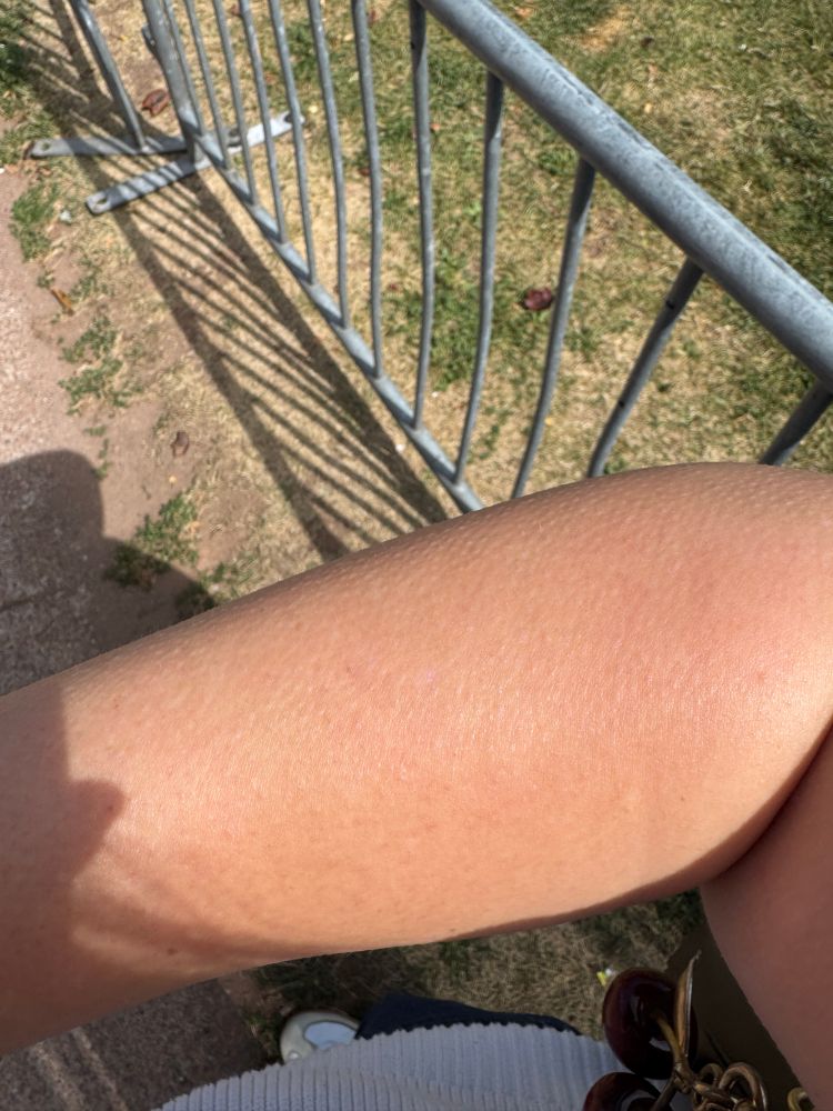 M arm with goosebumps all over 