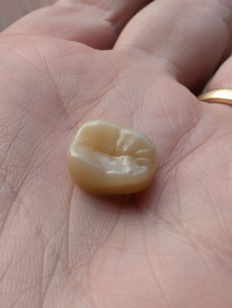 A tooth crown I have that used to have in my mouth but is now in the palm of my hand