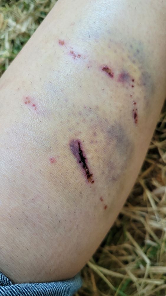 Photo of my leg showing broken skin and bruising from a dog bite while riding a motorcycle