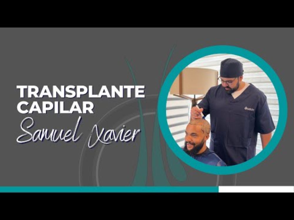 Transplante capilar do Samuel Xavier