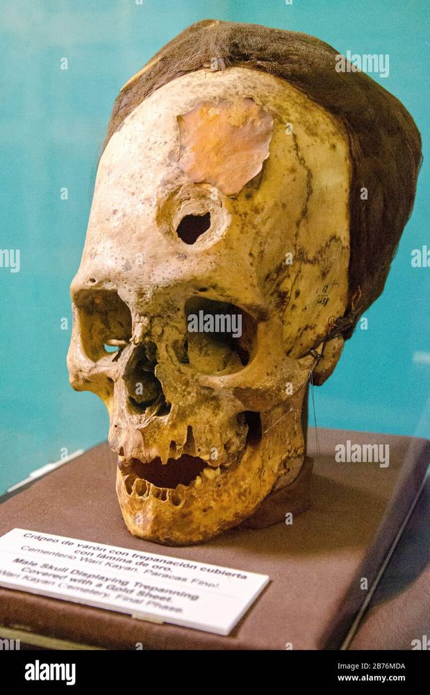 Peruvian trepanned skull. It’s oblong and has a drill hole in the front 