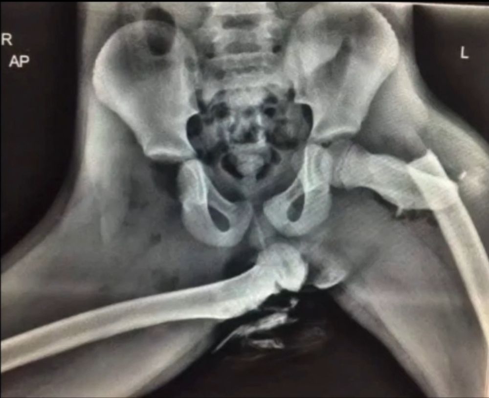 A young woman who has been injured in motor accidents.
Bilateral femur fracture and severe dislocation.
#Accident #vehicle #Motor #trauma #injury