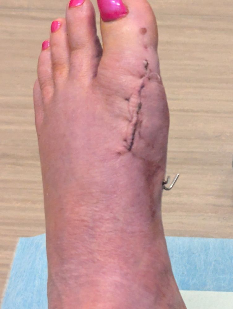 My left foot with pretty pink toenails and a long incision down the big toe. Two pieces of metal stick out on the right - the pins holding something together inside. 