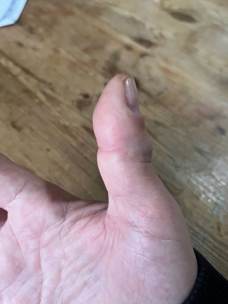 Gebrochener Daumen nach Angriff von dosentrotteln
