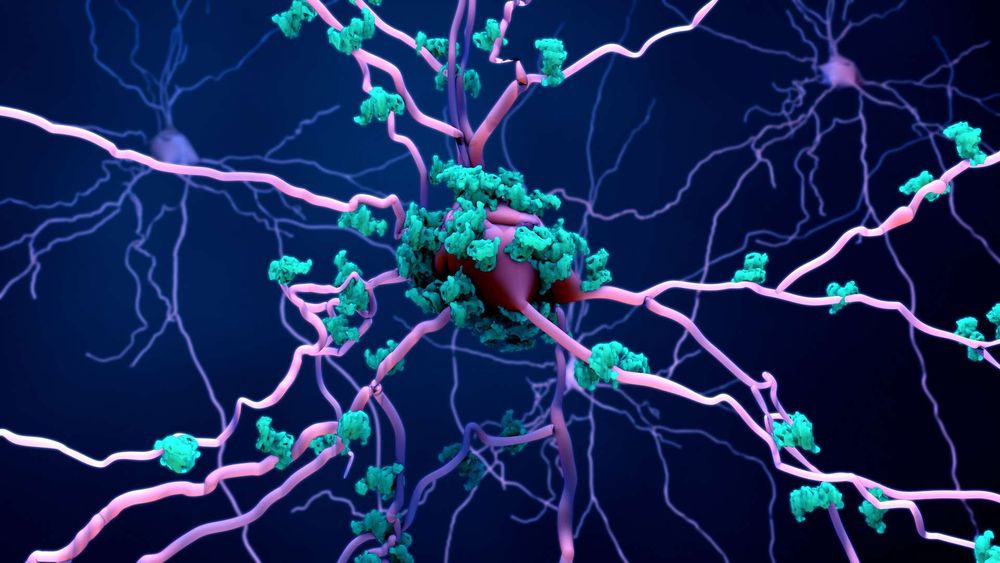 Alzheimer : le médicament qui pourrait stopper la destruction des neurones