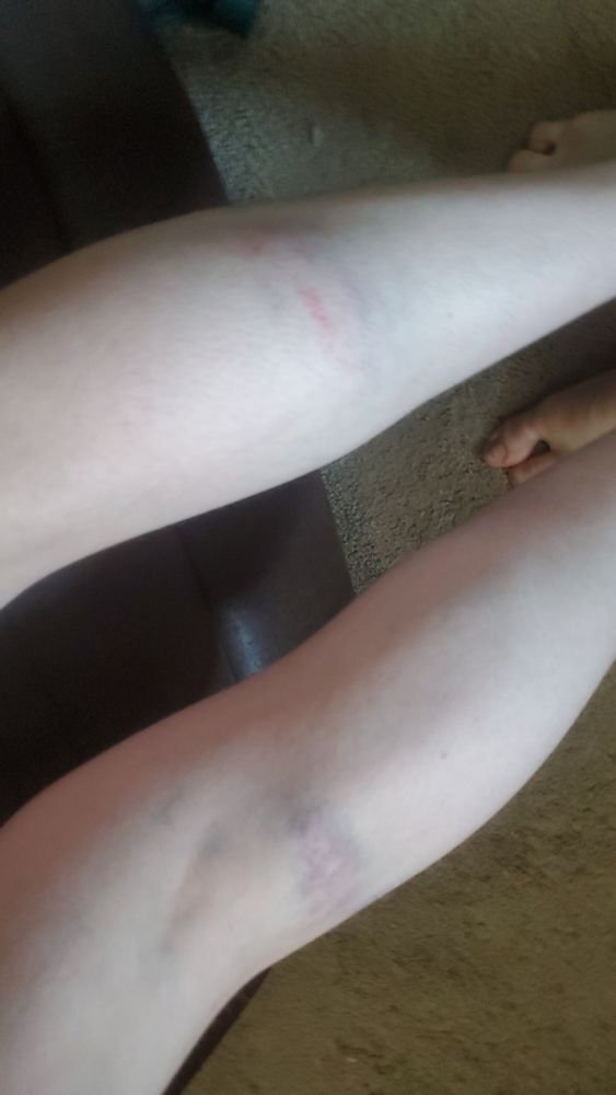 Bruised legs