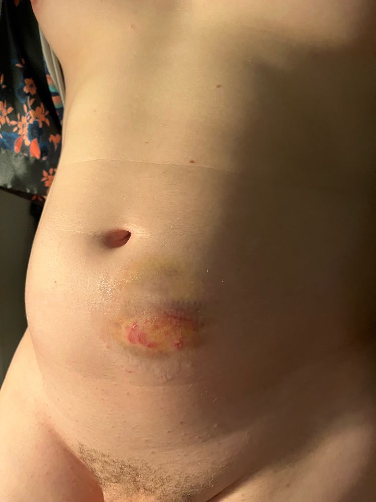Bite wound on stomach 