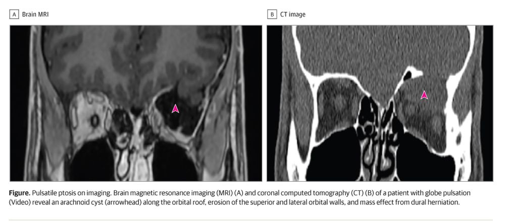 Brain MRI and CT scan showing an arachnoid cyst (arrowhead) along the orbital roof, erosion of the superior and lateral orbital walls, and mass effect from dural herniation.
