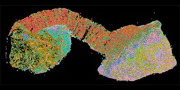 Spatial gene expression map in a colorectal tumour sample (Source: Yurike Laurensia, Li Bo, and Grace Yeo, Prabhakar Lab, A*STAR’s GIS)