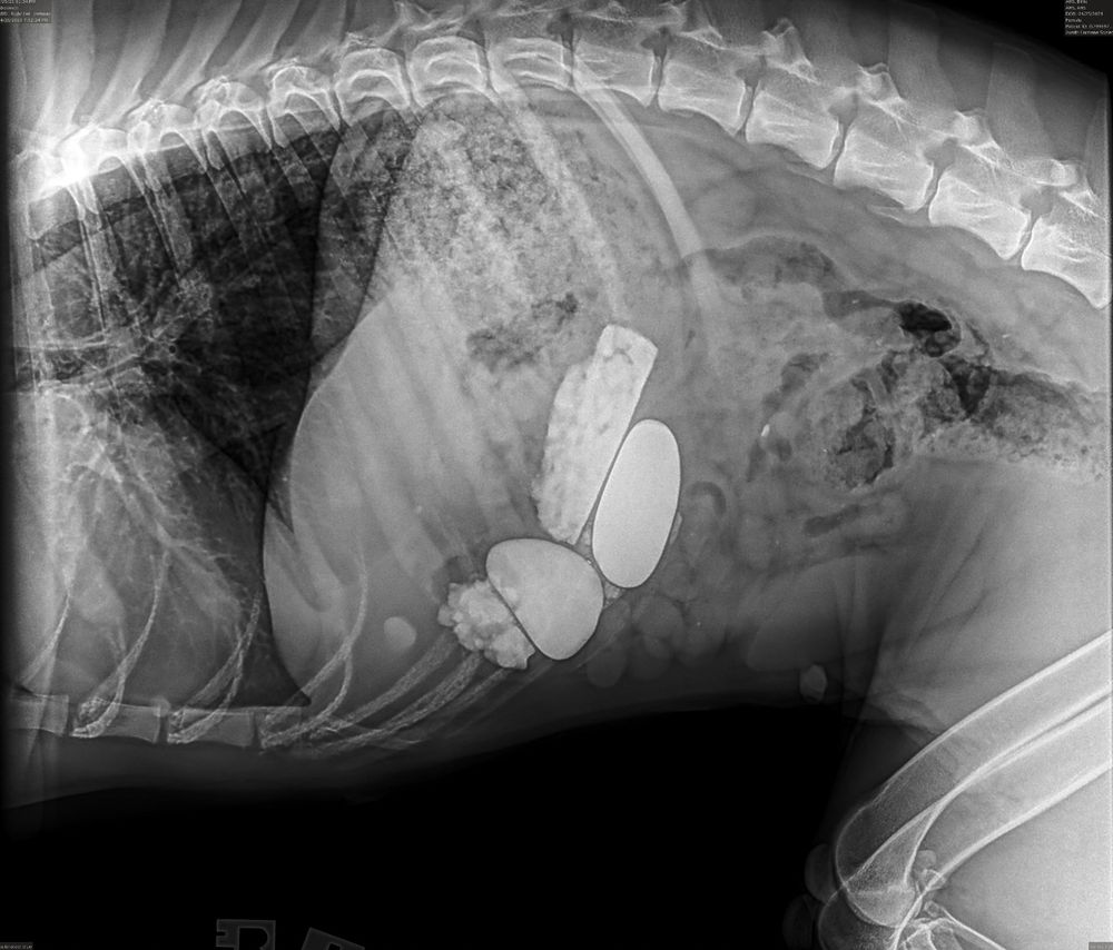 an x-ray reveal highlighting several large stones obstructing Billie's intestines.