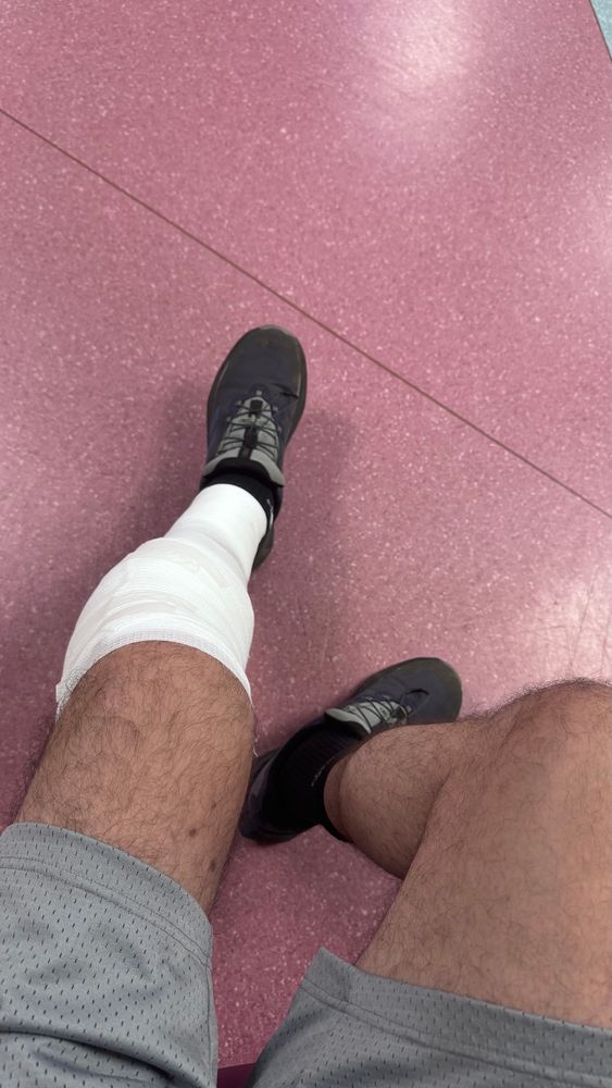 A picture of a leg WITHOUT an Ilizarov frame 