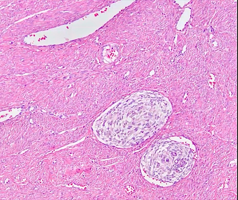 LVI