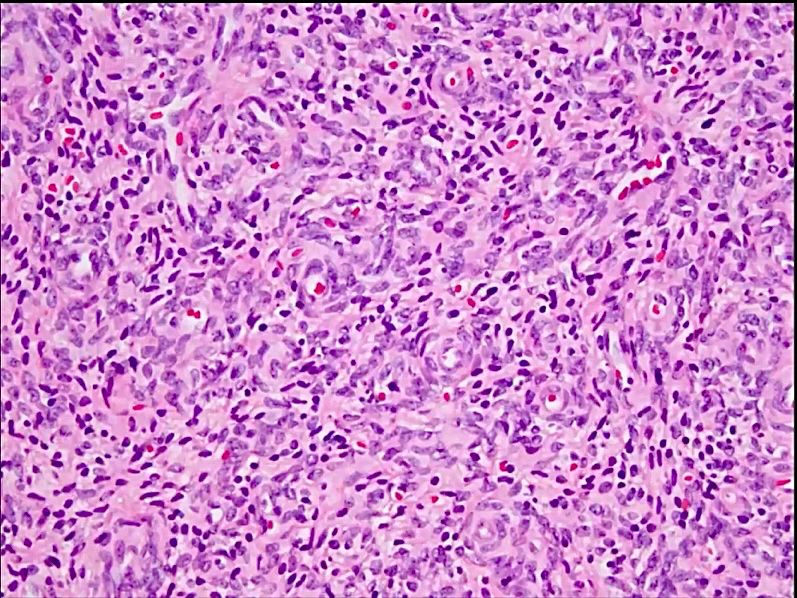 Monotonous oval to spindle cells with minimal cytologic atypia, often demonstrating whorling around blood vessels