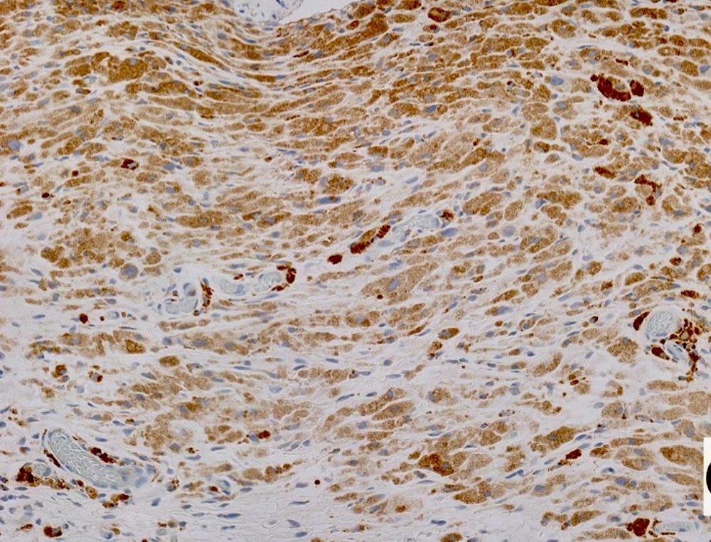 CD68 immunohistochemical stain
