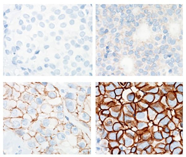 Score 0, 1+, 2+, 3 by IHC of a breast carcinoma