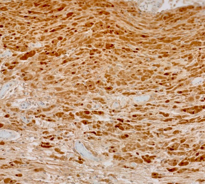 S100 immunohistochemical stain