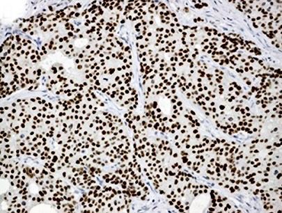 Androgen receptor immunohistochemical stain