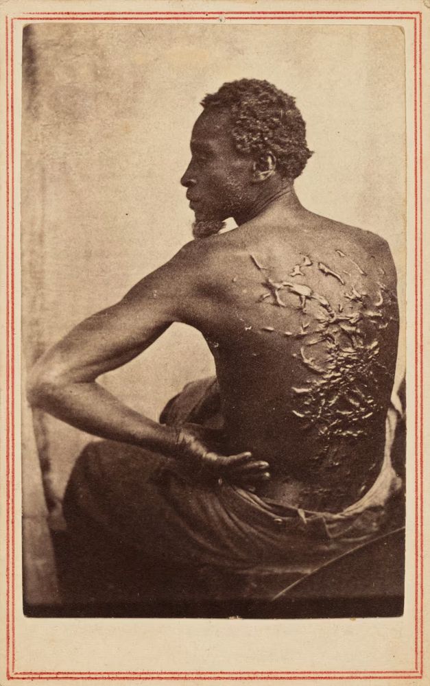 Severely scarred back of a whipped slave. circa 1863.