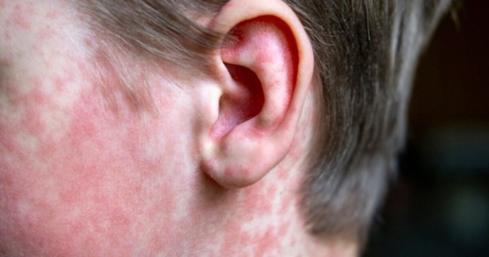 San Diego County has confirmed its first measles case of 2025. Officials say a teenager who was not immunized recently traveled overseas and was infected.
