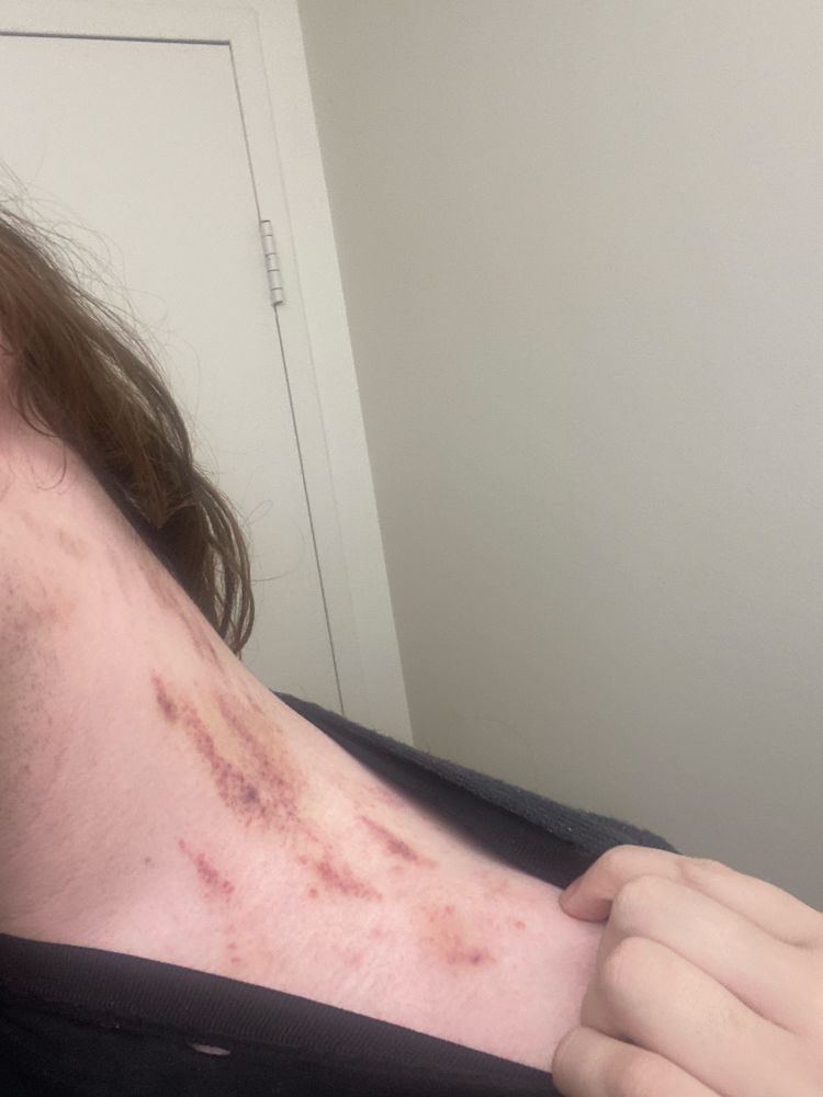 the side of skye’s neck, covered in bruises and bite marks