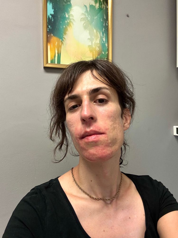 a hottie poses for a selfie her beautiful face covered in angry red splotches from the permanent hair removal