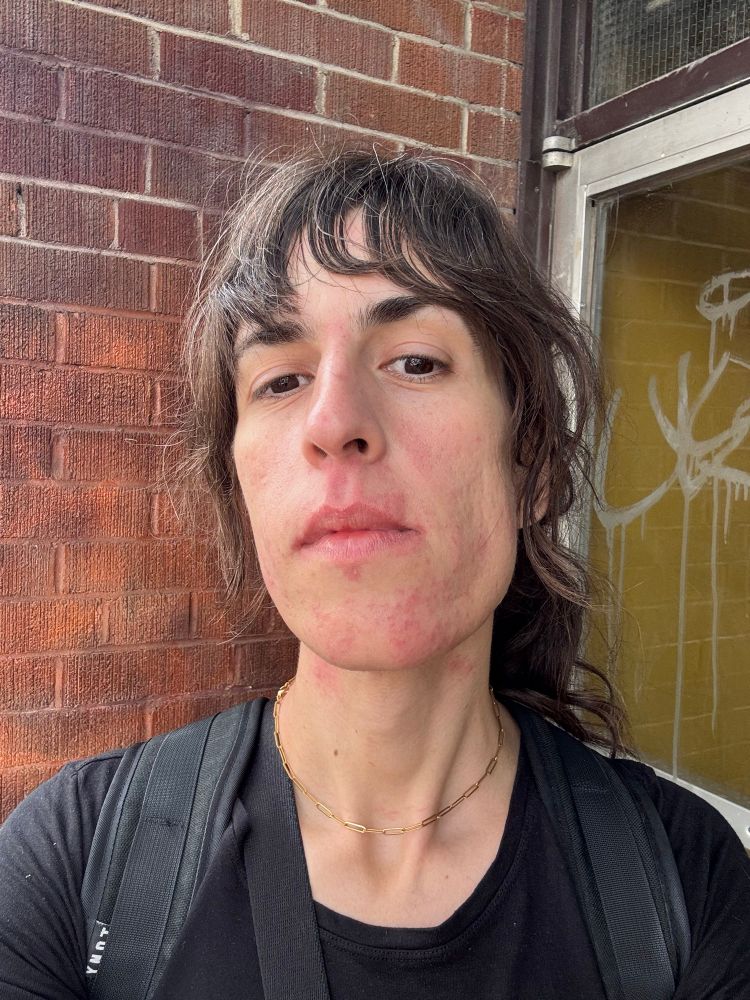 a brunette stares into the camera, her face covered in angry red splotches - the aftermath of her electrolysis hair removal session