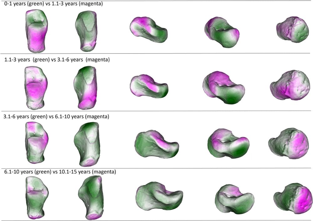 Displacement heatmaps showing calcaneal shape differences between age groups means. Green represents the younger age group in each comparison, while magenta represents the older age group in each comparison. Colors mapped to the older age group in each comparison depict vertices that extend beyond (magenta) the mesh (which represents the younger age group in each comparison). The distance is calculated by superimposing the meshes of the two age groups for each comparison. For instance, the magenta color of the calcaneal body in the first comparison (0–1 year vs. 1.1–3 years) means that the 1.1–3 years group extends beyond the calcaneal body of the 0–1 year group. After the onset of independent walking, there is a proximodistal elongation of the calcaneal body and a slight increase in the medial projection of the sustentaculum tali. The cuboid facet angle starts to change in its lateral part. With the achievement of more mature locomotor kinematics, between 3 and 6 years of age, the posterior talar facet changes in orientation and lateral-medial elongation. The calcaneal body and the sustentaculum tali continue to lengthen, which increases in size and morphology. After six years of age, mostly all remaining changes are concentrated on the metaphyseal area, that is, calcaneal tuberosity, and lateral part of the cuboid facet. The posterior talar facet continues to develop, and the anterior talar facet undergoes major developmental changes as the sustentaculum tali develops.