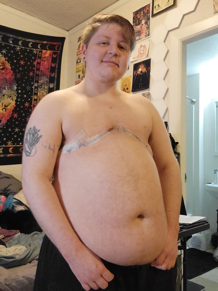 Q standing in their room, looking at the camera, they no longer have tits and instead you can see medical tape covering their top surgery stiches.