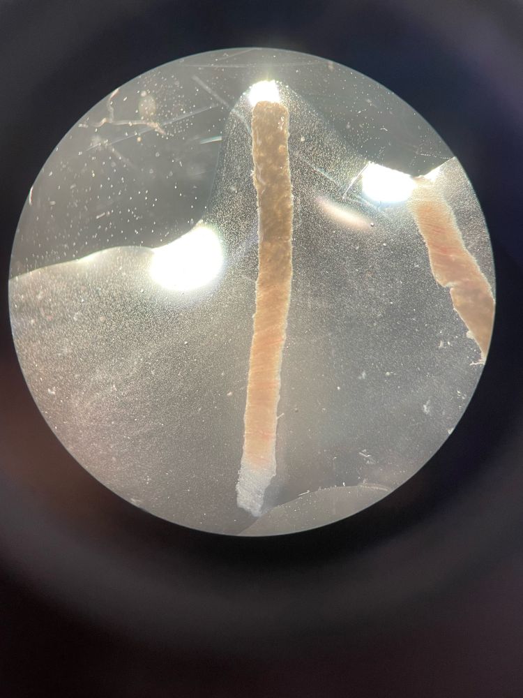 Needle biopsy sample of a kidney. The top portion of the sample is cortex containing glomeruli, the bottom with parallel lines is all medulla. 