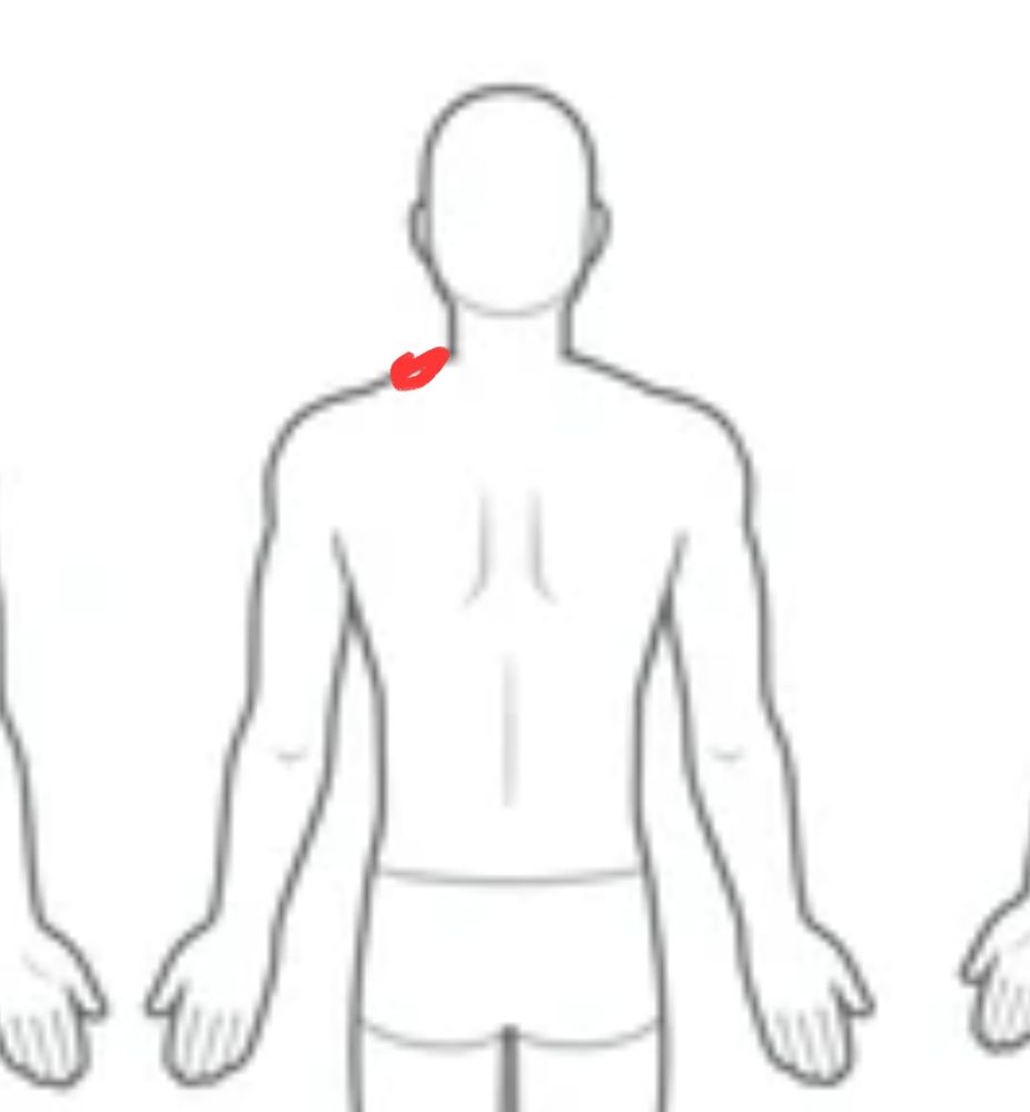 Skiss av mansrygg, med en klumpig klump av rött där jag upplevde ryckningar på morgonen. 