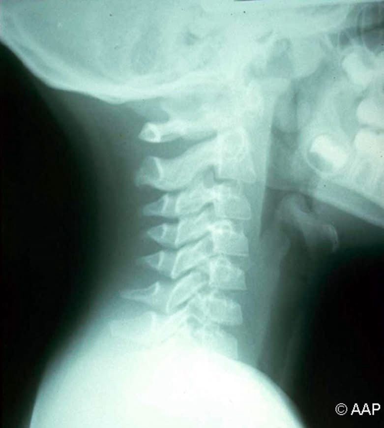 X Ray showing epiglottis 