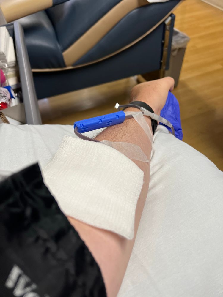 An arm with a cloth and tubes in it while donating blood.