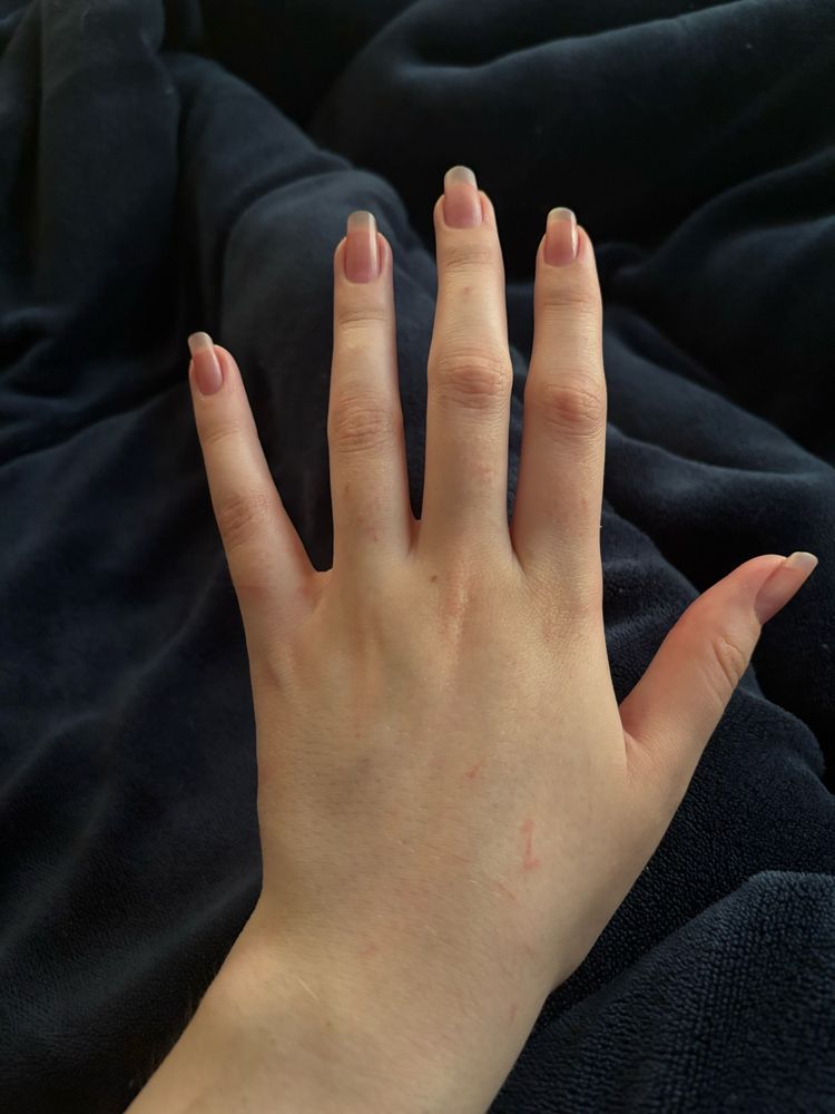 photo of my hand with a bunch of tiny scratch marks all over it