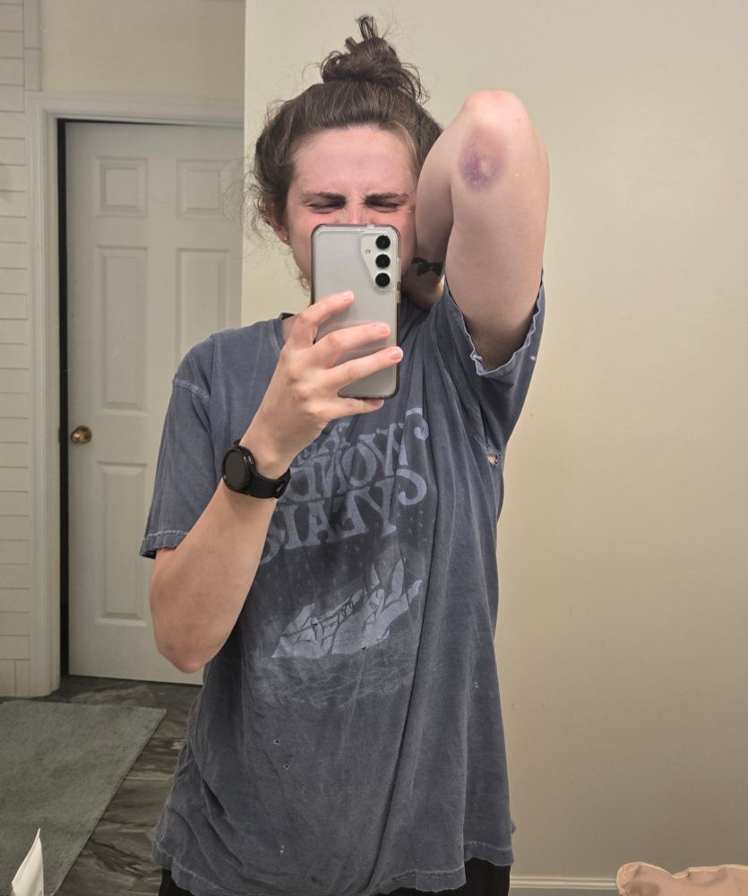 Ashes taking a picture in the mirror. Her elbow is held up showing a big purple bruise. She is wearing a blue "the wonder years" shirt and her hair is up in a bun on top of her head