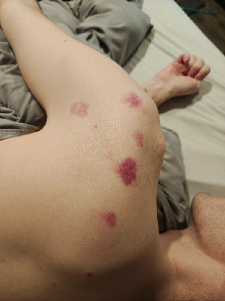 5 massive hickeys on the back of my shoulder from my husband