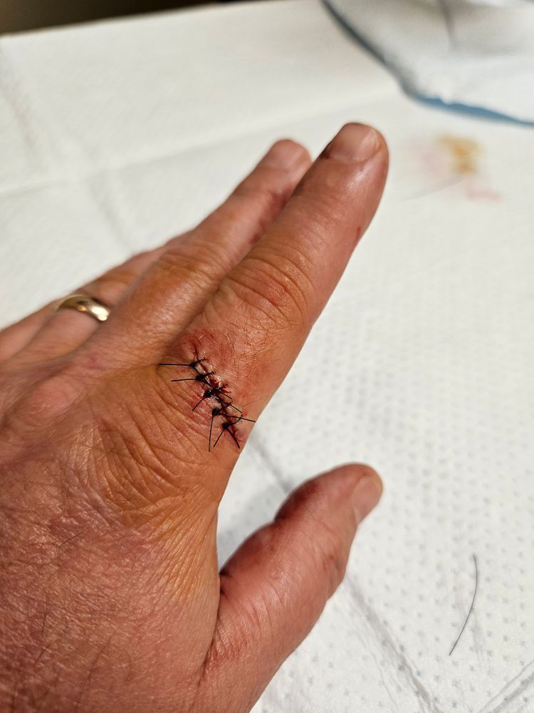 The left hand with the index finger laceration, now bearing five stitches.