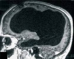 Holoprosencephaly, which are diagnosed with brain scans like MRI. Brain scan.