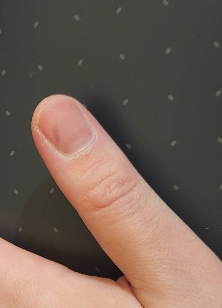 photo of my thumb with a red, diagonal bruise under the nail