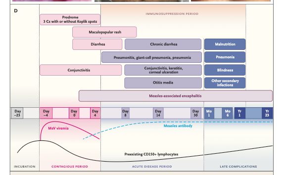 Features of measles include Koplik spots on the buccal mucosa (Panel A); rash on the trunk, spreading to the face, head, arms, and legs
(Panel B); and conjunctivitis (Panel C). Day 0 denotes the day the measles rash appears; Day −4 is the probable start of infectiousness,
Day 4 is the probable end of infectiousness, and Day −23 is the earliest possible exposure day (Panel D). CD150+ lymphocytes are T and
B memory lymphocytes targeted by measles vaccine. 3 Cs denotes cough, coryza, and conjunctivitis, and MeV measles virus. Images in
Panels A, B, and C were provided by Du Tuan Quy, M.D., with the approval of Le Nguyen Thanh Nhan, M.D., Ph.D., Children’s Hospital 1,
Ho Chi Minh City, Vietnam.