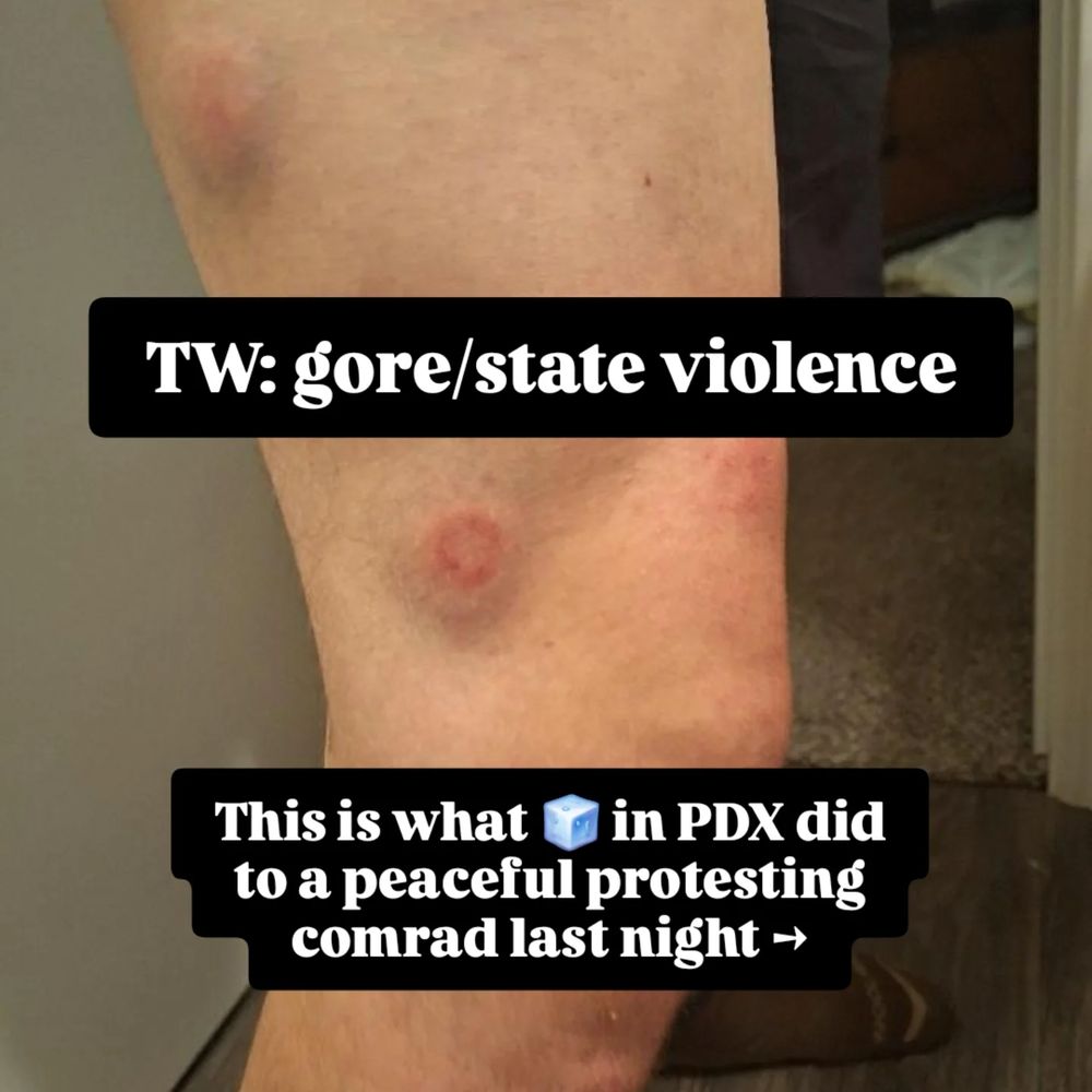 Bruises on a white leg from being shot with rubber bullets straight on. Welting and swelling are evident. Text reads 'tw:gore/state violence, this is what (ice emoji) in pdx did to a peaceful protesting comrad last night -> 