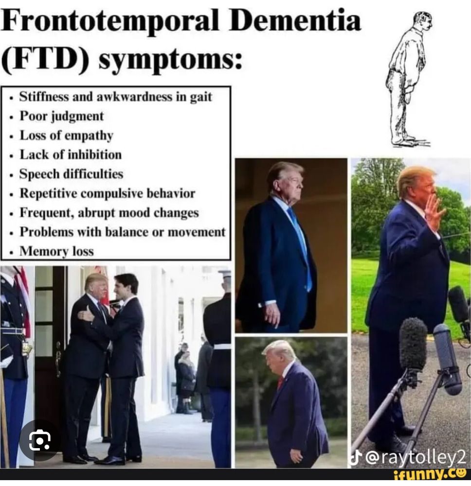 A meme with the title: Frontotemporal Dementia (FTD) symptoms: Underneath the title is a white square with black text inside reading: •Stiffness and awkwardness in gait •Poor judgement •Loss of empathy •Lack of inhibition •Speech difficulties •Repetitive compulsive behavior •Frequent, abrupt mood changes •Problems with balance or movement •Memory loss It then displays along the right hand side and bottom a 4 photo collage showing various pictures of President Trump displaying a pronounced forward lean. There is also a pencil black and white drawing, that looks like it is from a textbook, of a person displaying a forward lean while standing. One of the photos is President Trump shaking hands with Canadian Prime Minister Justin Trudeau and Trump has a very obvious forward lean while shaking Trudeau’s hand, to the point where Prime Minister Trudeau had to stick one leg/foot behind himself instead of standing with two legs together side by side, in order to brace himself (Trump is leaning so far forward towards Justin Trudeau, his chest is almost touching Trudeau’s chest.)