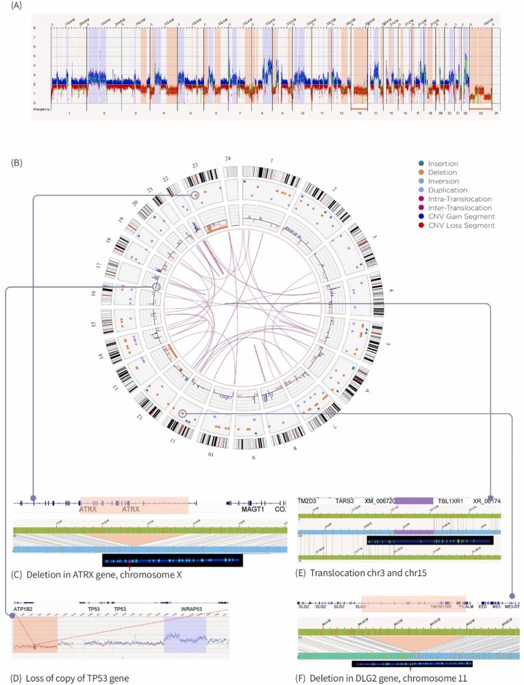 Full denovo assembly of a sarcoma U2OS cell with Bionano Genomics. CNC & Circus plots showing all structural variants 