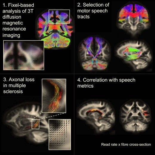 Visual abstract of the paper. It shows the four key methodology steps: 
1. fixel-based analysis of 3T diffusion MRI
2. selection of motor speech tracts in the brain
3. visualisation of axonal loss in multiple sclerosis
4. correlation of axonal damage and loss with speech metrics

These steps are presented alongside images showing white matter tracts and tract damage.