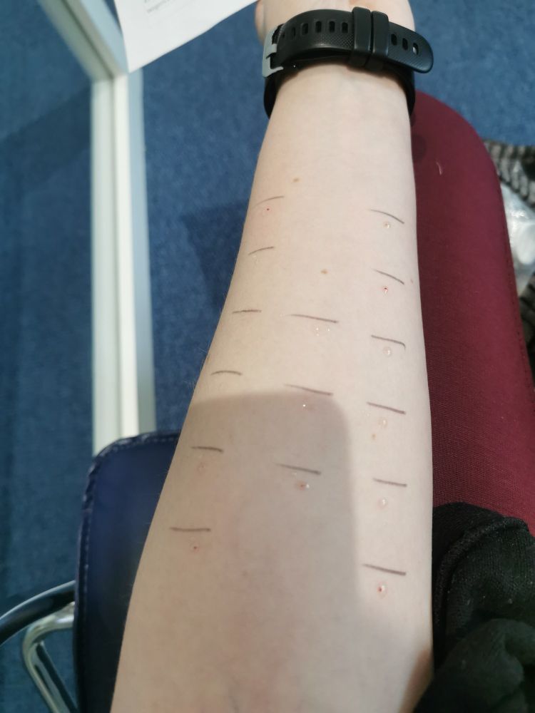 Auf dem Bild ist mein Unterarm zu sehen, auf dem ein Allergietest gemacht wird.
Es sind 15 verschiedene Testlösungen, die jeweils mit einem schwarzen Strich voneinander abgetrennt sind.