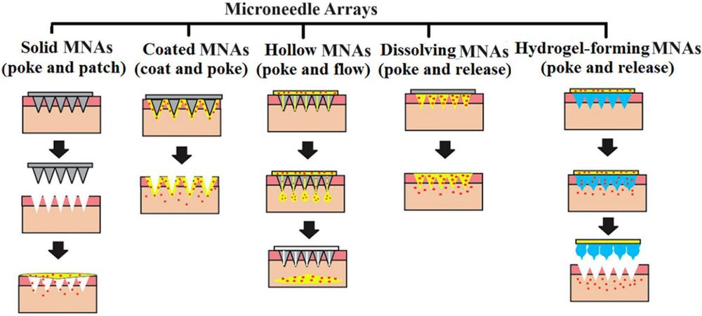 graphical depiction of 5 types of microneedle arrays - solid MNAs, Coated MNAs, Hollow MNAs, dissolving MNAs and hydrogel-forming MNAs. Fig 1 from tcsme-2024-0114