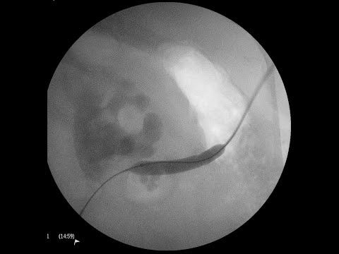PCNL  Access  "As Live" cases