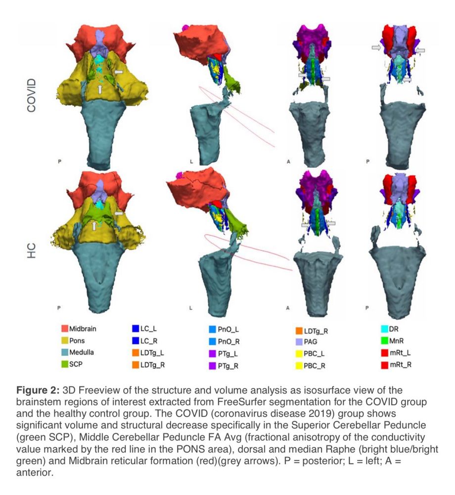 Figure 2: 3D Freeview of the structure and volume analysis as isosurface view of the brainstem regions of interest extracted from FreeSurfer segmentation for the COVID group and the healthy control group. The COVID (coronavirus disease 2019) group shows significant volume and structural decrease specifically in the Superior Cerebellar Peduncle (green SCP), Middle Cerebellar Peduncle FA Avg (fractional anisotropy of the conductivity value marked by the red line in the PONS area), dorsal and median Raphe (bright blue/bright green) and Midbrain reticular formation (red) (grey arrows). P = posterior; L = left; A = anterior.